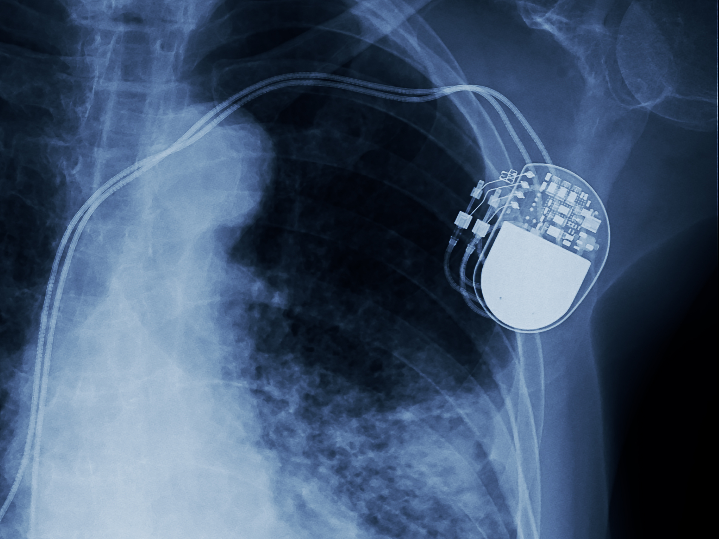 Implantable Medical Device
